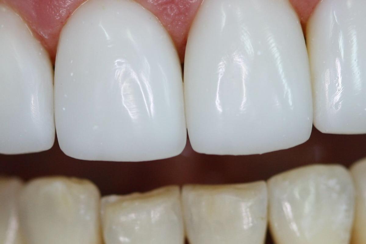 Почему разрушается эмаль зубов?